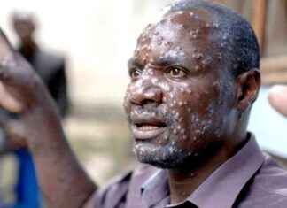 Preparing for MPOX Outbreak: UK Braces for Cases Amid Global Emergency news-15082024-174721